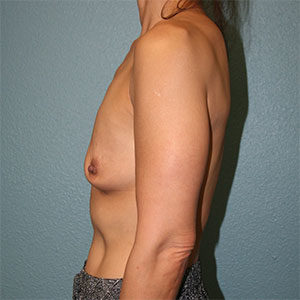 Breast Augmentation