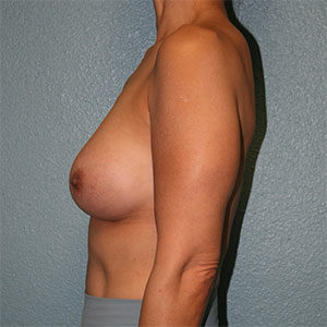 Breast Augmentation