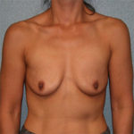 Breast Augmentation