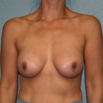 Breast Augmentation