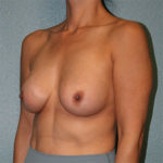 Breast Augmentation