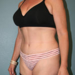 Tummy Tuck