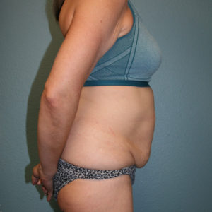 Tummy Tuck