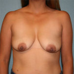 Breast Augmentation
