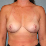 Breast Implant Removal