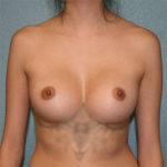 Gummy Bear Breast Implants