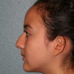 Nose Surgery (Rhinoplasty)