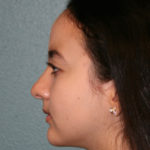 Nose Surgery (Rhinoplasty)