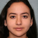 Nose Surgery (Rhinoplasty)