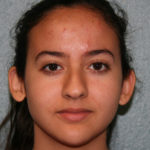 Nose Surgery (Rhinoplasty)