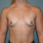 Breast Augmentation