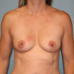 Breast Augmentation