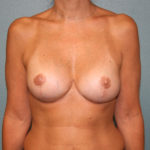 Breast Implant Revision