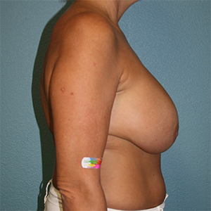 Breast Implant Removal