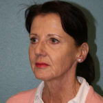 Face Lift