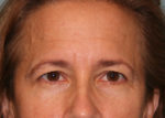 Eyelid Surgery