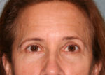 Eyelid Surgery