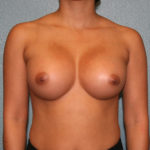Breast Augmentation