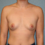 Breast Augmentation