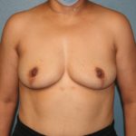 Breast Implant Removal