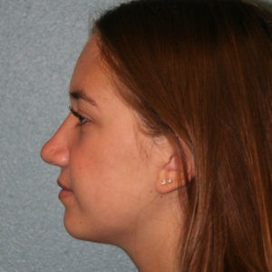 Nose Surgery (Rhinoplasty)