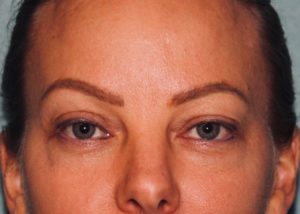 Eyelid Surgery