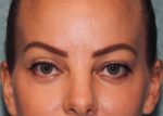 Eyelid Surgery