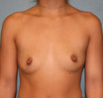 Breast Augmentation