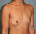 Breast Augmentation