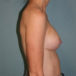 Gummy Bear Breast Implants