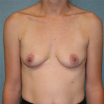 Gummy Bear Breast Implants