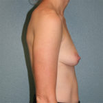 Gummy Bear Breast Implants