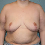 Breast Reduction