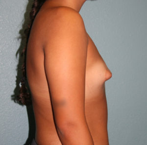 Breast Augmentation