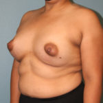 Breast Augmentation