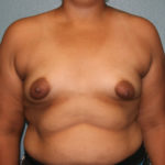 Breast Augmentation