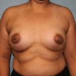 Breast Augmentation