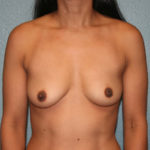Breast Augmentation