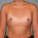 Gummy Bear Breast Implants