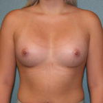 Gummy Bear Breast Implants