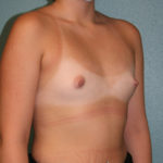 Gummy Bear Breast Implants