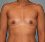 Breast Augmentation