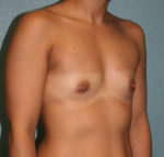 Breast Augmentation