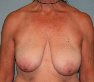 Breast Lift