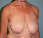 Breast Lift