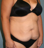 Tummy Tuck