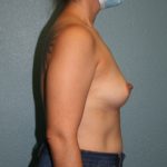 Gummy Bear Breast Implants