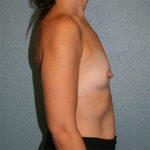 Breast Augmentation