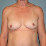 Gummy Bear Breast Implants