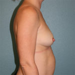 Gummy Bear Breast Implants